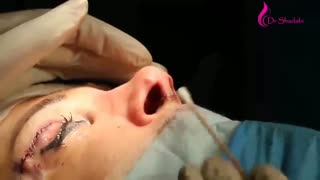 جراحی بلفاروپلاستی بلافاصله بعداز عمل