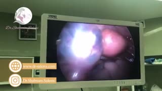 عمل لاپاراسکوپی حاملگی خارج رحم