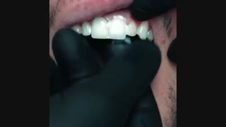 ونیر دندانی