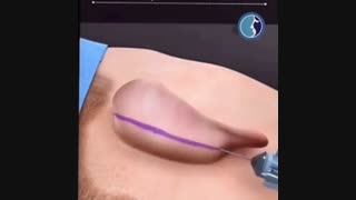 فیلمی از مراحل عمل زیبایی گوش