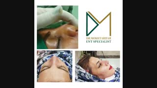 سه هفته پس از جراحی بینی مراجعه کننده عزیزمون از شهر دزفول استان خوزستان که بینی به شدت گوشتی با غضروفهای ضعیف داشتن