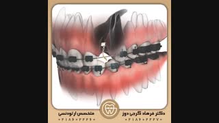 درمان نیش نهفته با ارتودنسی | دکتر فرهاد گرجی دوز