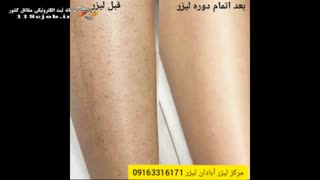 مرکز لیزر موهای زائد آبادان لیزر با دستگاه الکساندرایت در آبادان