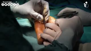 دوپویترن کف دست و انگشت