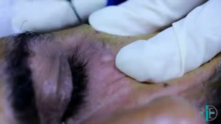 دستگاه Endo-RF Subcision