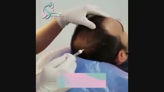 فیلم واقعی تزریق فیلر به مو