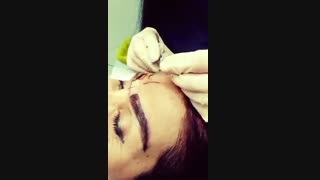 عمل کاشت ابرو