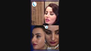 رضایت بیمار یک ماه بعد از جراحی زیبایی بینی | متخصص گوش و حلق و بینی | دکتر محمد گلی
