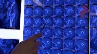 شکستگی گردن ران در خانم جوان ۴۰ ساله