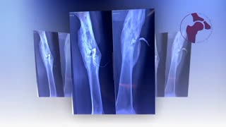 عفونت مزمن استخوان