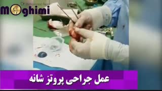 فیلم واقعی و بدون سانسور جراحی پروتز شانه