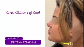 فیلم واقعی لیفت با نخ و مادلینگ صورت