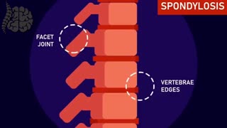 انیمیشن جالب در مورد کمردرد و درمان آن