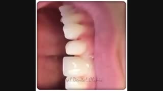 روکش دندان مزیت های زیادی برای فرد به دنبال دارد | کلینیک دندانپزشکی ایده آل