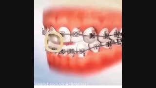 ارتودنسی دندان زیبایی