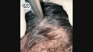فیلم رویش مجدد موهای از دست رفته با دستگاه فوتونا