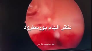 عمل هیستروسکوپی