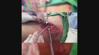 ویدئو واقعی آزادسازی عصب سطحی ران در شیراز
