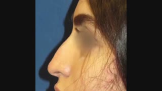 عمل بینی استخوانی به روش بسته