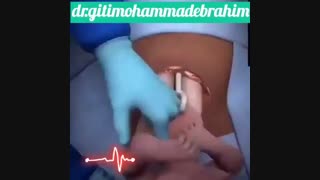 انیمیشن جذاب و دیدنی از زایمان سزارین