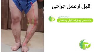 فیلم واقعی قبل و بعد جراحی زانو در شیراز