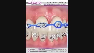 زنجیر پلاستیکی (پاور چین ارتودنسی) | کلینیک تخصصی دندانپزشکی کانسپتا