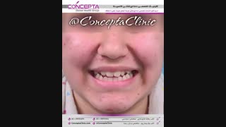 درمان ارتودنسی ثابت دو فک بدون کشیدن دندان | کلینیک تخصصی دندانپزشکی کانسپتا