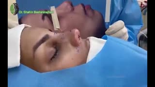 جراحی بینی ترمیمی با از بین رفتن کلیه زیرساخت های بینی | دکتر باستانی نژاد