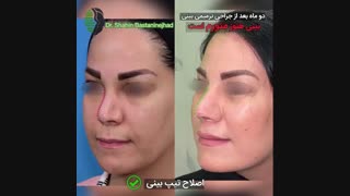 دو ماه بعد از جراحی ترمیمی بینی با سابقه چند بار جراحی و سوراخ تیغه بینی | دکتر باستانی نژاد