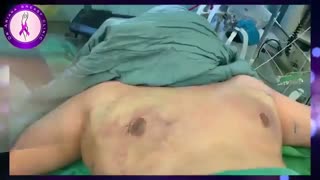 اصلاح ژنیکوماستی شدید در آقای 37 ساله