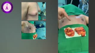 اصلاح ژنیکوماستی شدید