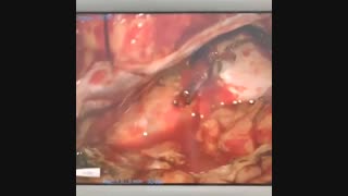 تومور مننژیوم اولفکتوری