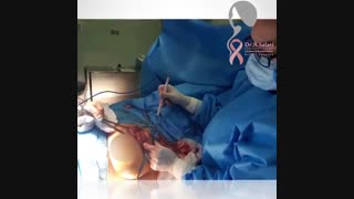 جراحی سرطان پستان با حفظ پستان