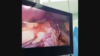 فیلم واقعی جراحی اسلیو معده