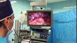 فیلم عمل جراحی لاپاراسکوپی کیست لوزالعمده