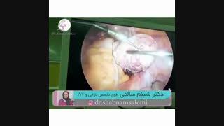 لاپاراسکوپی میومکتومی