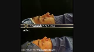 بلافاصله بعد از عمل زیبایی بینی توسط دکتر امید ابراهیمی، بهترین جراح بینی