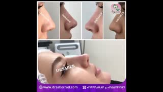 فیلر بینی و چانه