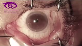 فیلم واقعی کانالیکولیت( التهاب و عفونت مجاری اشکی)