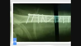 جراحی شکستگی دوبل ساعد در آقای 33 ساله