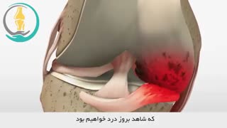 استئوآرتریت زانو