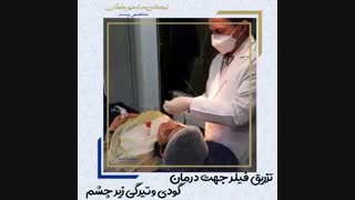 نکاتی بسیار مهم درباره ی تزریق فیلر زیر چشم