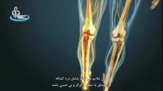 عصب سیاتیک | متخصص ارتوپد | دکتر محمد ابراهیم طاهریان