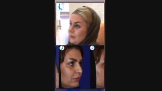 رضایت بیمار سه هفته بعد از جراحی زیبایی بینی | متخصص گوش و حلق و بینی | دکتر محمد گلی