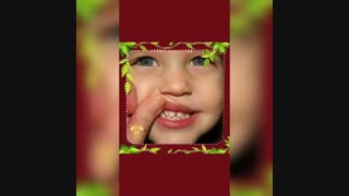 چه دندانهایی بیشتر در معرض ترک و یا شکستگی هستند