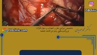 تومور مغزی در کودکان