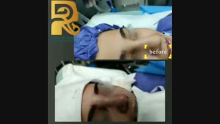نمونه جراحی بینی گوشتی با پروجکشن کم و تیغه استخوانی پهن