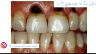 لمینت دندان سرامیکی میکرونیدلینگ