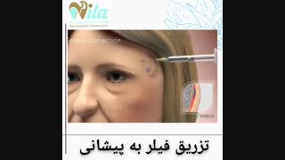 تزریق فیلر به پیشانی زیبایی پوست