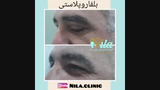 جراحی بلفاروپلاستی پلک بالا